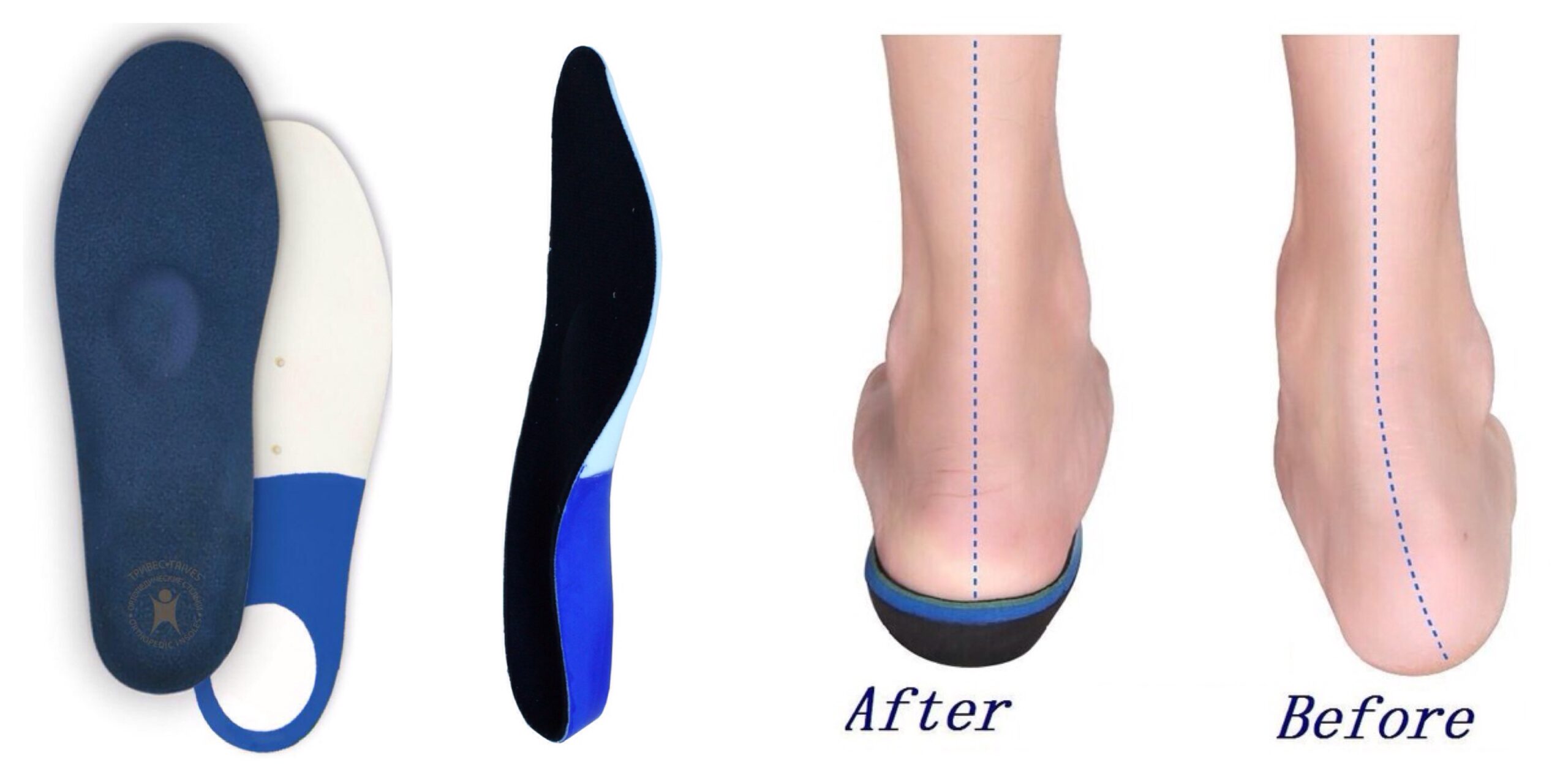 Ортопедическая стелька при вальгусной деформации стопы